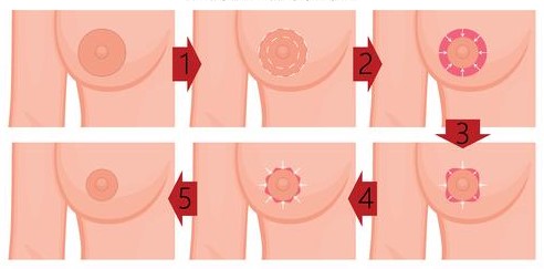 Areola Reduction Surgery Sydney