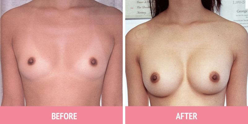 Best Breast Augmentation Sydney