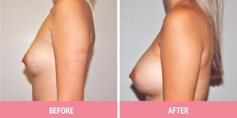 Best Breast Augmentation Sydney