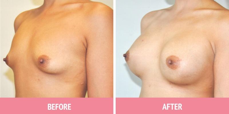 Best Breast Augmentation Sydney