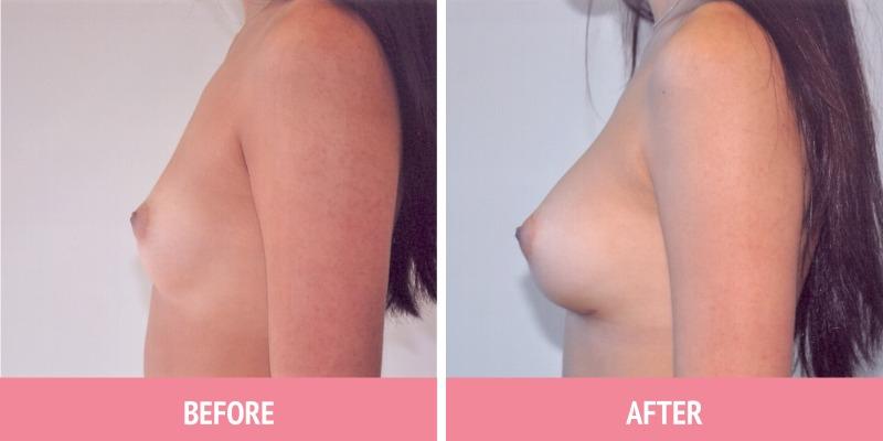 Best Breast Augmentation Sydney