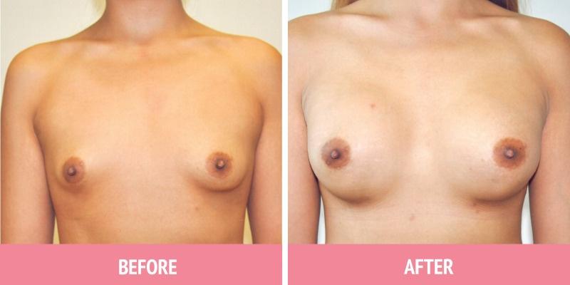 Breast Augmentation Sydney