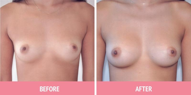 Breast Augmentation Surgery Sydney