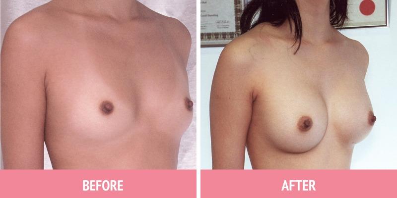 Breast Augmentation Sydney