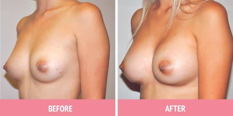 Breast Augmentation Sydney