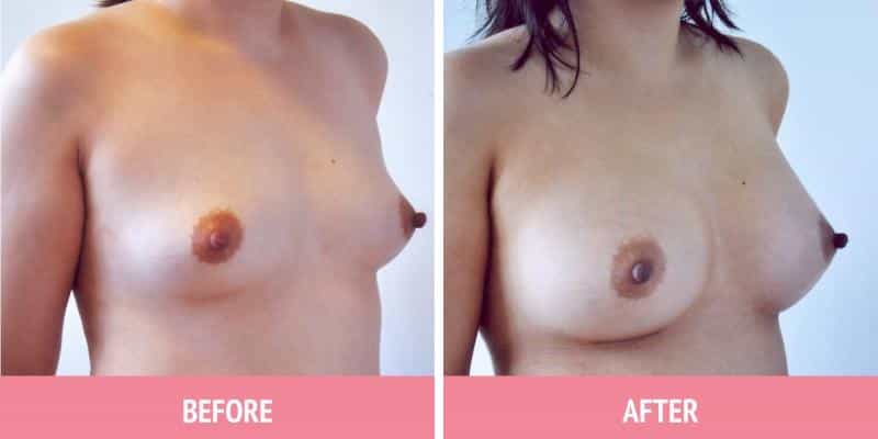 Breast Augmentation Sydney