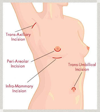 Breast Implant Incision Types