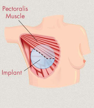 Breast Implant Position