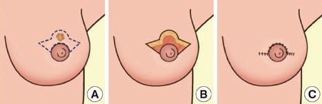 Breast Lift Before and After