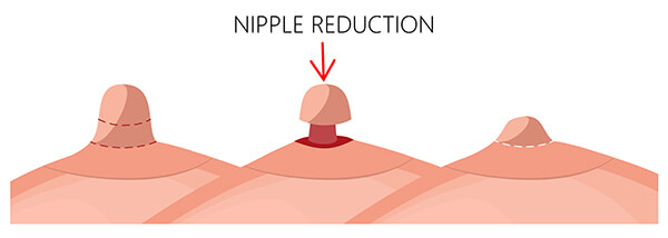 Nipple Reduction Surgery