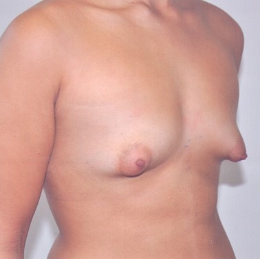 Tuberous Breast Correction