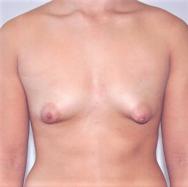 Tuberous Breast Correction Surgery