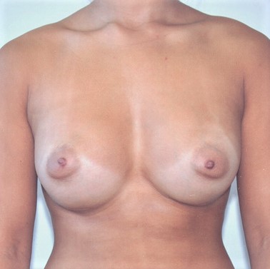 Tuberous Breast Correction Surgery