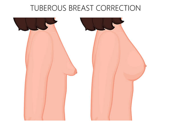 Tuberous Breast Correction Surgery