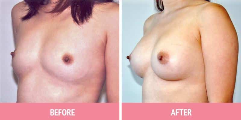 Best Breast Augmentation Sydney