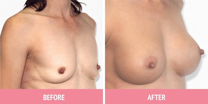 Best Breast Augmentation Sydney