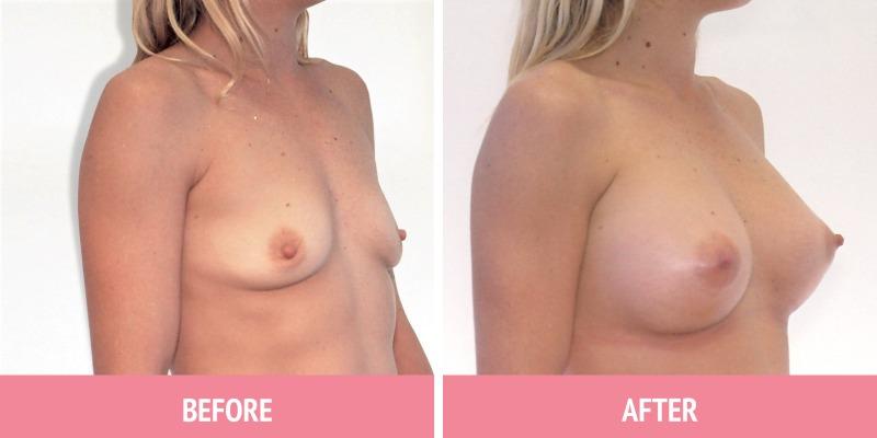 Best Breast Augmentation Sydney