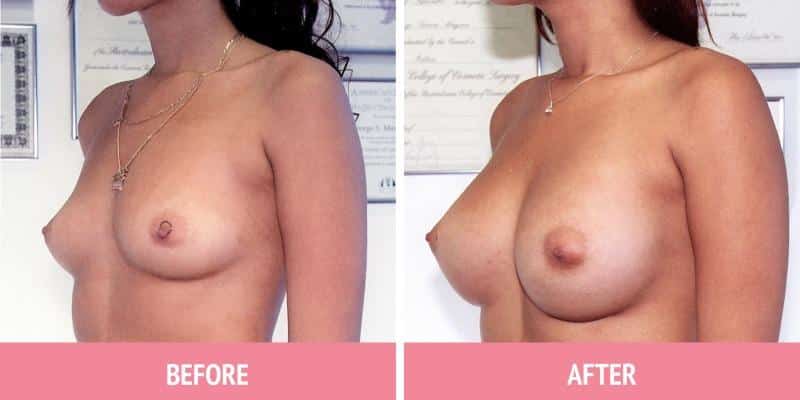 Best Breast Augmentation Sydney