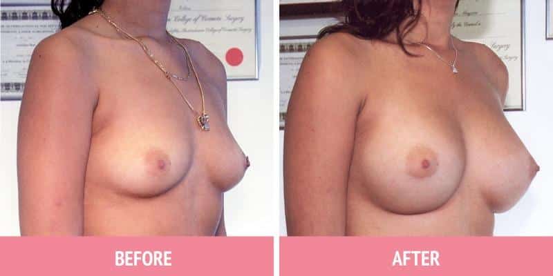 Best Breast Augmentation Sydney