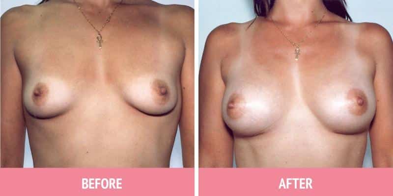 Best Breast Augmentation Sydney