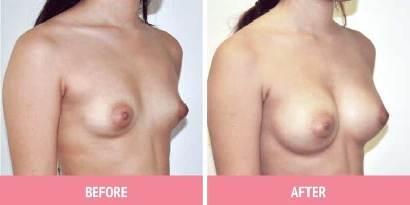 Best Breast Augmentation Sydney