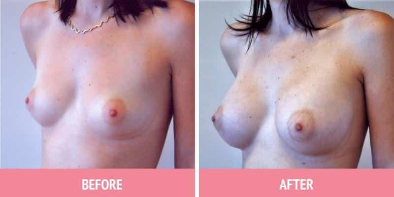 Best Breast Augmentation Sydney