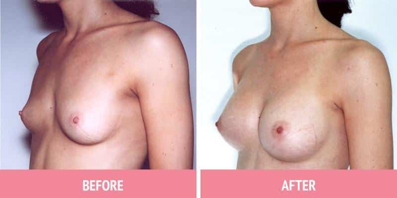 Best Breast Augmentation Sydney