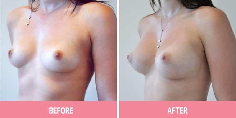 Best Breast Augmentation Sydney