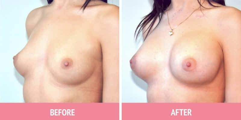 Best Breast Augmentation Sydney