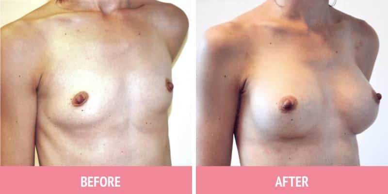 Best Breast Augmentation Sydney