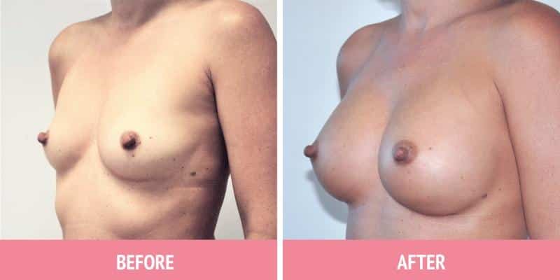 Best Breast Augmentation Sydney