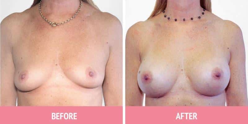 Breast Augmentation Sydney