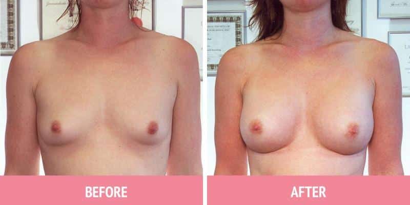 Breast Augmentation Sydney