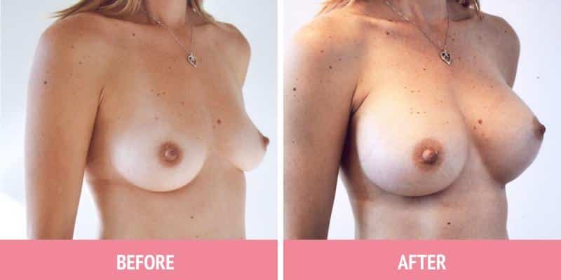 Breast Augmentation Surgery Sydney