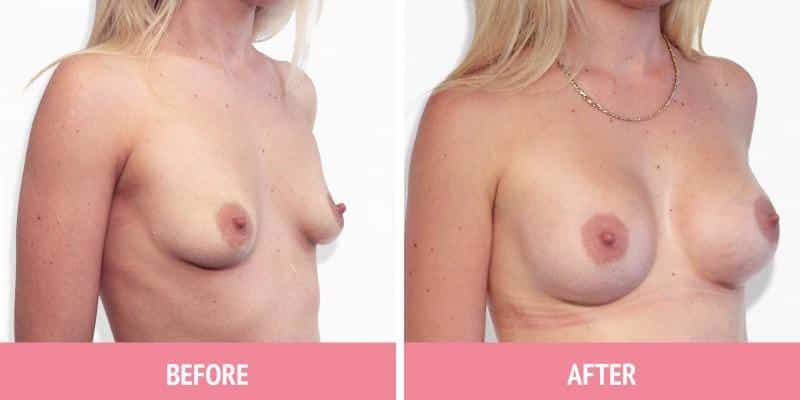 Breast Augmentation Surgery Sydney