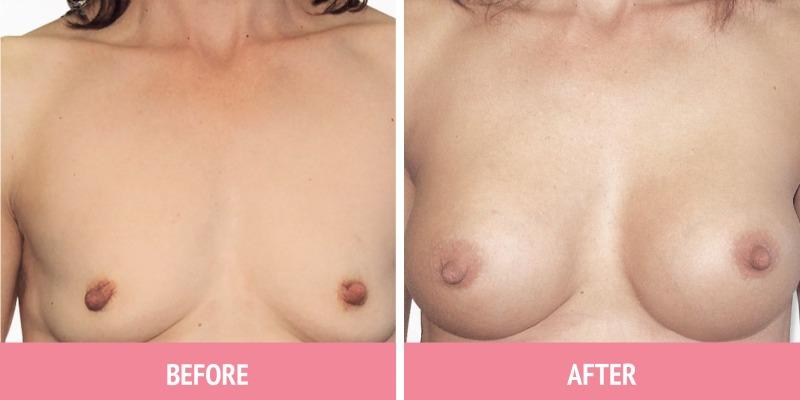 Breast Augmentation Surgery Sydney