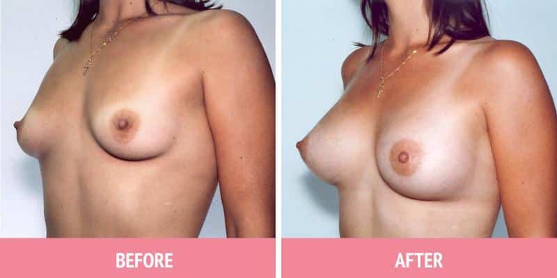 Breast Augmentation Surgery Sydney