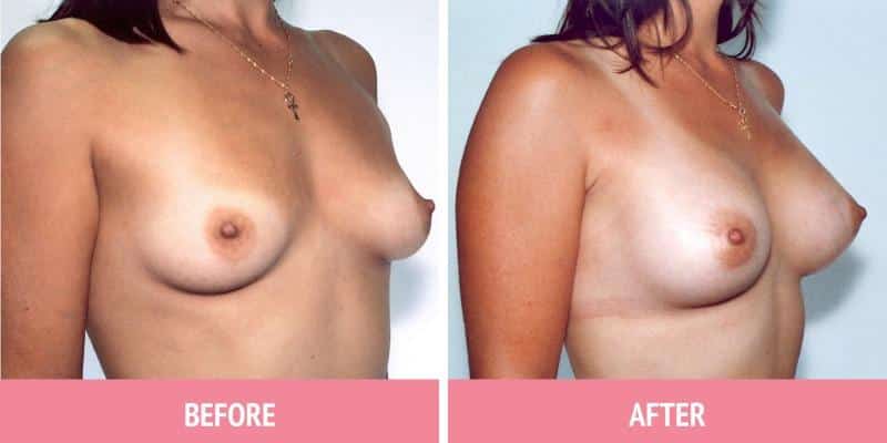 Breast Augmentation Surgery Sydney