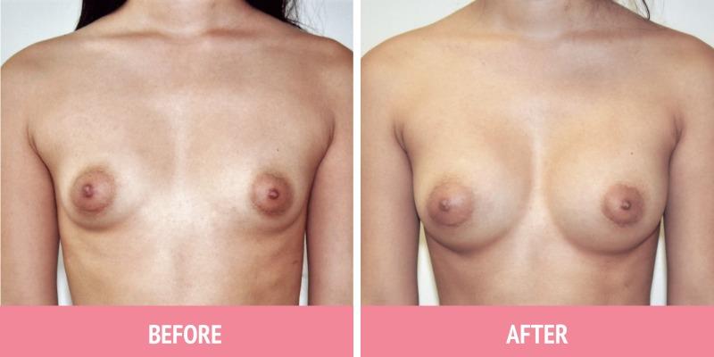 Breast Augmentation Surgery Sydney