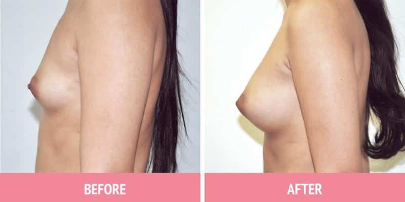 Breast Augmentation Surgery Sydney