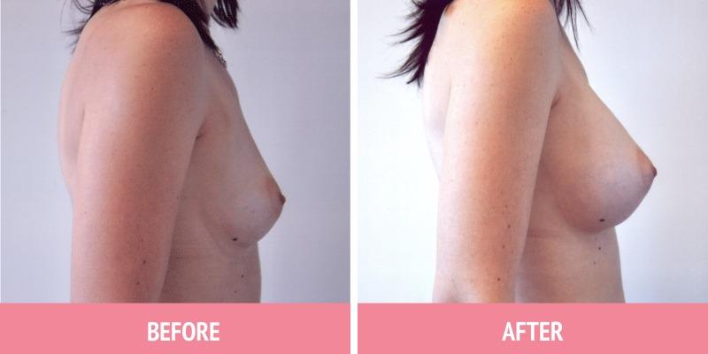 Breast Augmentation Surgery Sydney