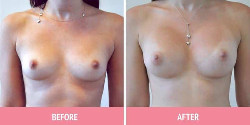 Breast Augmentation Surgery Sydney