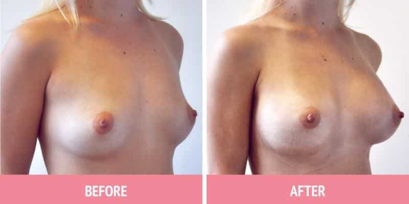 Breast Augmentation Surgery Sydney