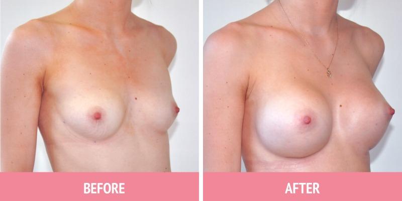 Breast Augmentation Surgery Sydney