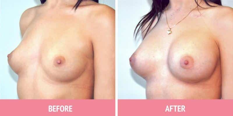 Breast Augmentation Surgery Sydney