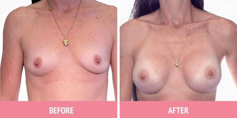 Breast Augmentation Sydney