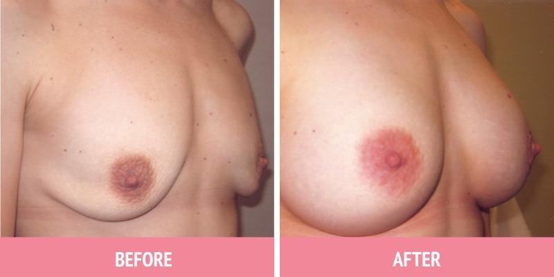 Breast Augmentation Sydney