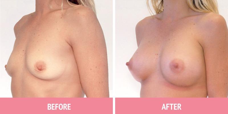 Breast Augmentation Sydney