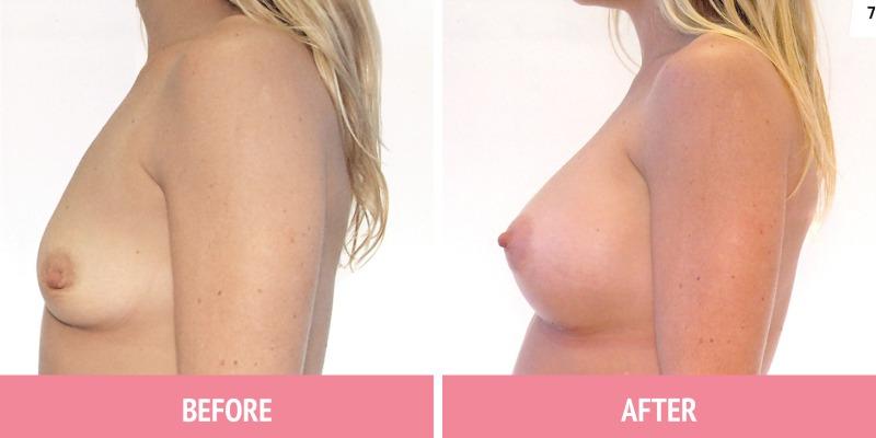 Breast Augmentation Sydney