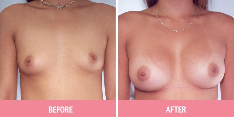 Breast Augmentation Sydney